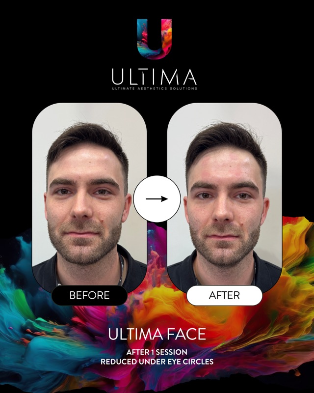 ULTIMA Face eredmény — férfi arc, szem alatti karikák csökkenése, 1 alkalom