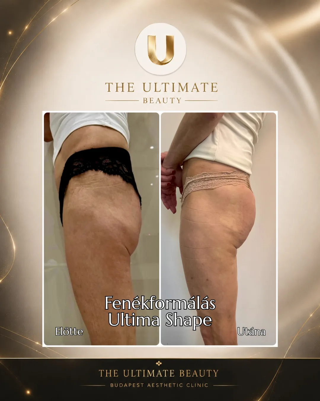 Fenékformálás előtte-utána — Ultima Shape