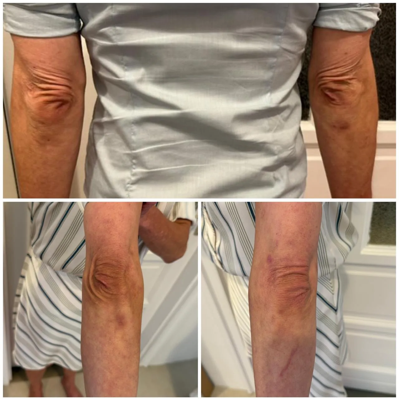 Sculptra-kezelés eredménye a könyök területén